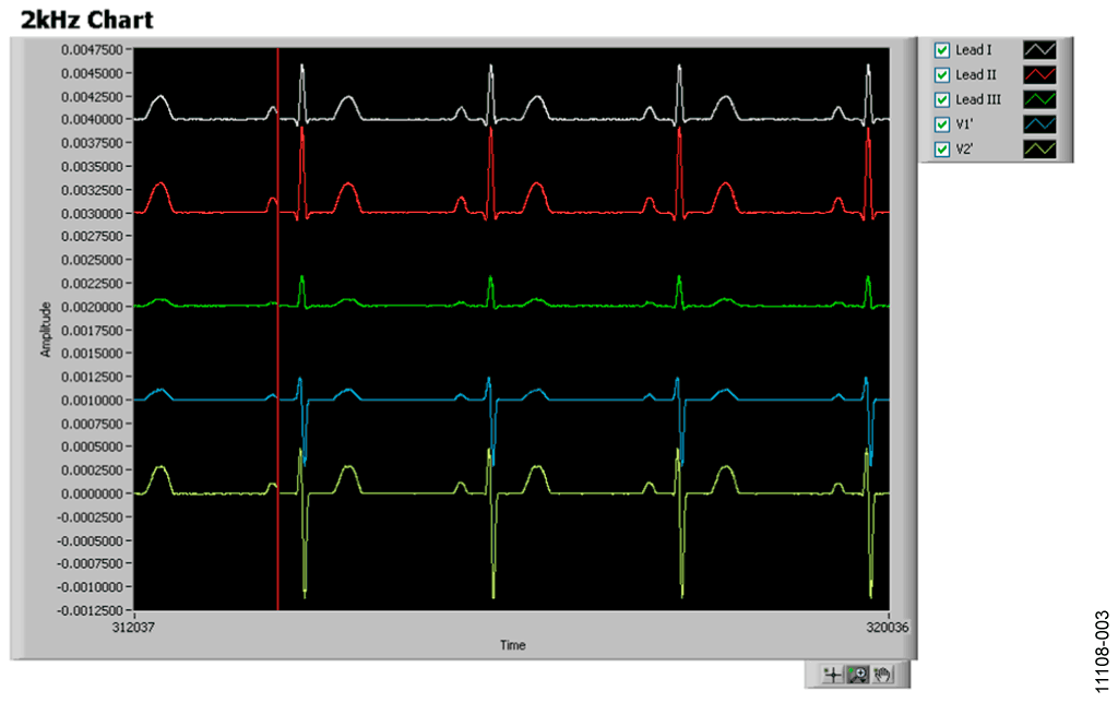Screen Capture of ADAS1000 with Patient Simulator Connected, Heart Rate = 70 BPM